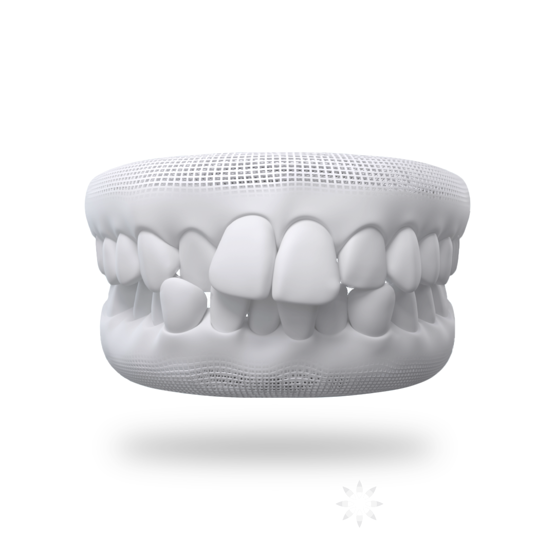 Crowded Teeth